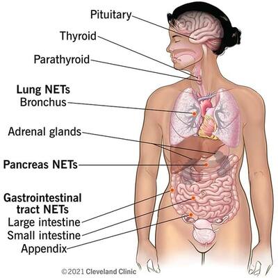 PRRT Nuclear Therapy