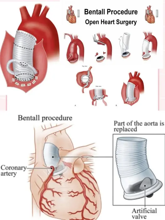 Bentall Procedure Performed