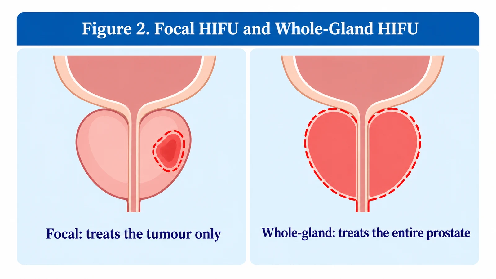 Figure 2. Focal HIFU treats the tumour only, while Whole-Gland HIFU treats the entire prostate