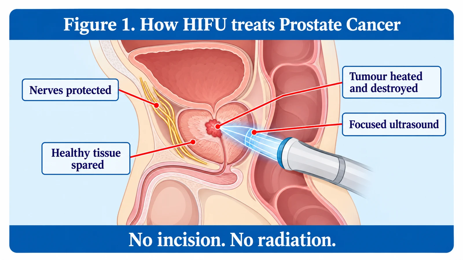 Figure 1. How HIFU treats Prostate Cancer: focused ultrasound from a probe heats and destroys the tumour while healthy tissue and nerves are spared, with no incision and no radiation