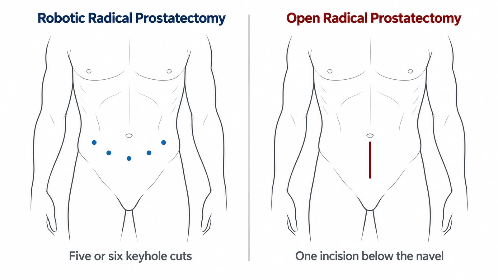 Five keyhole ports for Robotic Radical Prostatectomy compared with one incision below the navel for Open Radical Prostatectomy