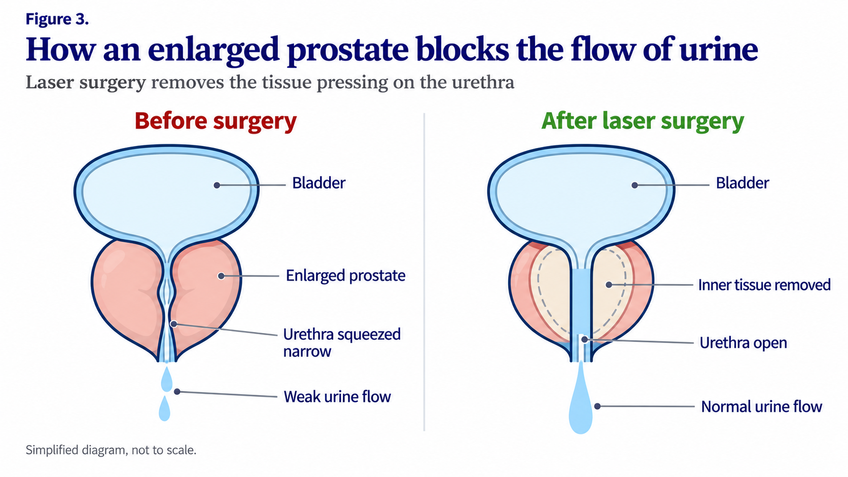 Figure 3. How an enlarged prostate blocks the flow of urine: before surgery the enlarged prostate squeezes the urethra narrow, after laser surgery the inner tissue is removed and the urethra is open